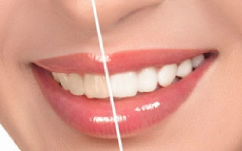 Blanqueamiento Dental: Lo Que Debes Saber Antes de Hacerte el Tratamiento